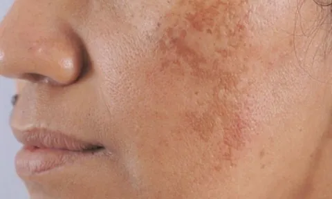 Bạn bị đốm đồi mồi, tàn nhang thường là do 3 điều này, hãy chủ ý đển chúng để có làn da đẹp