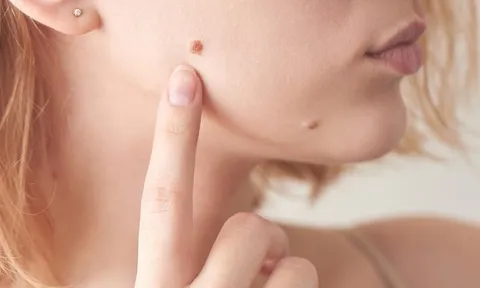 3 vị trí mọc nốt ruồi dễ thành ung thư da: Cảnh báo đừng xem thường