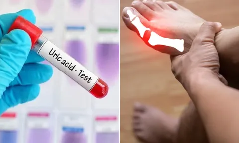 8 cách đơn giản giúp đào thải axit uric ra khỏi cơ thể, phòng ngừa bệnh gout