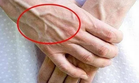 Vì sao tay xuất hiện gân xanh? Cẩn thận nếu bạn có ở những vị trí này!