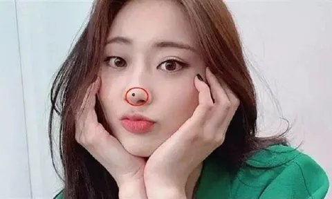 3 nốt ruồi chặn tài lộc: Ai không có thật đáng chúc mừng