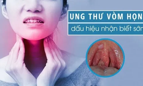 7 dấu hiệu K vòm họng: Số 1 không biết sớm khó mà chữa