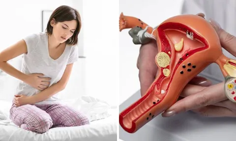 Dấu hiểu cảnh báo K cổ tử cung sớm: Phụ Nữ u 40 đang khoẻ mạnh cũng chớ xem thường