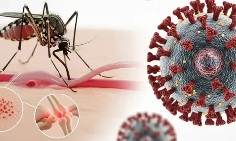 Bệnh Chikungunya đang có xu hướng bùng phát: Cảnh báo 2 nhóm người có nguy cơ mắc bệnh nặng hơn