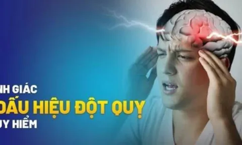 7 dấu hiệu cảnh báo đột quỵ trước 1 tuần: Nhận biết sớm để cứu mạng