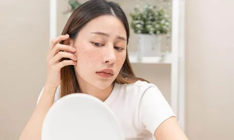 6 thói quen phổ biến khiến nám da ngày càng nặng hơn