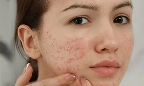 5 tác hại khi không rửa mặt sau khi đắp mặt nạ mà nhiều người không ngờ tới