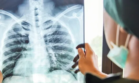 Vợ sống lành mạnh nhưng vẫn mắc K phổi giai đoạn cuối, nghi do một thói quen xấu của chồng