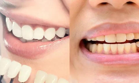 Nhìn màu răng đoán bệnh: Bác sĩ cảnh báo dấu hiệu nguy hiểm nhiều người bỏ qua