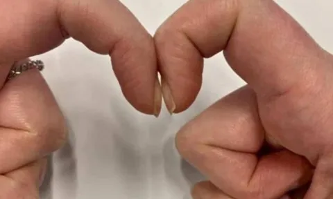 4 dấu hiệu bất thường trên ngón tay cảnh báo sớm ung thư gan, phổi
