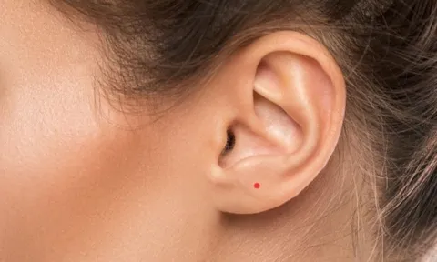 Nốt ruồi son là gì? Giải mã nốt ruồi son ở từng vị trí trên cơ thể