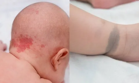 Cảnh báo: Những dấu hiệu 'nốt ruồi son - bớt - vết chàm' trên trẻ có thể tiềm ẩn nguy cơ bệnh lý