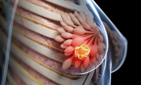 8 kiểu phụ nữ dễ bị K vú nhất: Xem bạn có trong số đó?