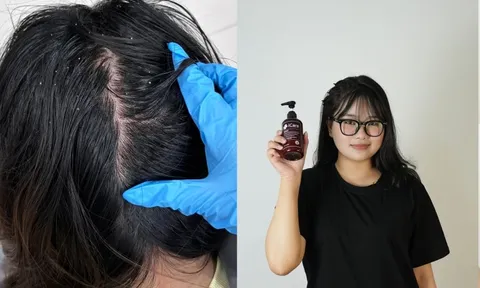 Trải nghiệm hết gàu ngứa của nữ sinh viên năm cuối: Kết quả bất ngờ từ dầu gội thảo dược?