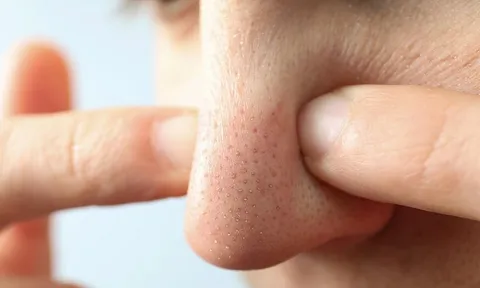 5 mẹo đơn giản đánh bay mụn đầu đen giúp da nàng láng mịn