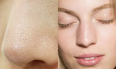 Ghim ngay 3 tips trị mụn cám vừa rẻ vừa hiệu quả chẳng tốn tiền đi spa