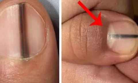 Móng tay có dấu hiệu này là gan đang "kêu cứu", đến gặp bác sĩ ngay!