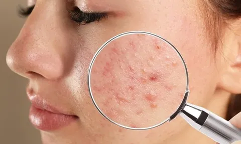 Cẩm nang chăm sóc các loại mụn ẩn nàng nên biết