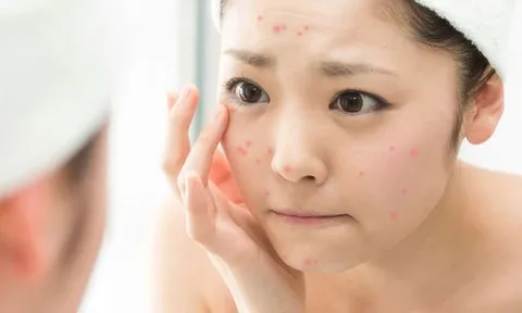 Mẹo nhỏ giúp bạn lấy lại làn da sạch mụn chỉ sau một đêm