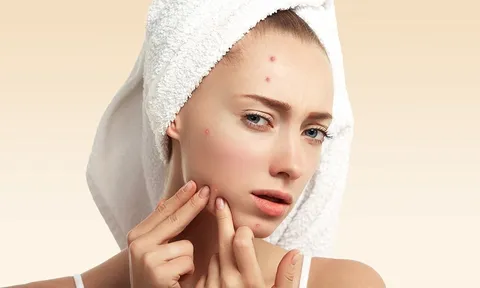 3 nguyên tắc cơ bản khi giảm sưng mụn viêm giúp da khỏe và nhanh láng mịn