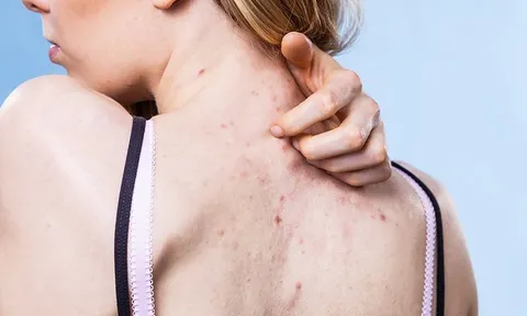 Nguyên nhân gây ra mụn lưng và biện pháp khắc phục tình trạng này.
