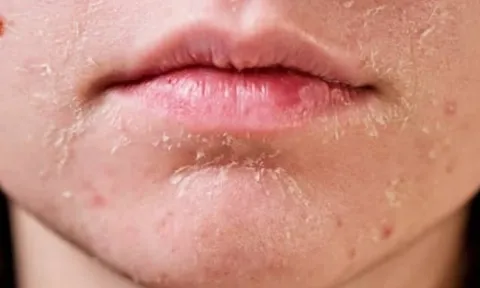 4 dấu hiệu thay đổi trên khuôn mặt cảnh báo ung thư cổ tử cung, phụ nữ cần lưu ý ngay