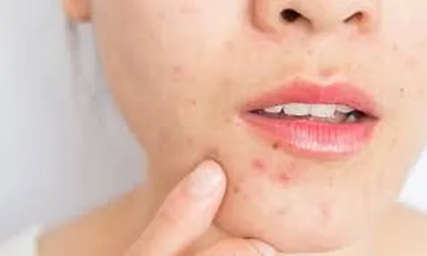 Nếu còn mắc 4 sai lầm này hàng ngày da bạn sẽ càng nổi nhiều mụn