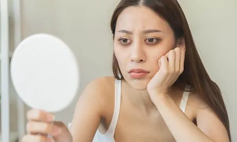 Chuyên gia bật mí tuyệt chiêu đỡ thâm và bọng mắt nhanh chóng