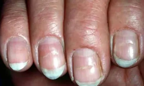 5 dấu hiệu bất thường trên móng tay cảnh báo ung thư: Đừng chủ quan kẻo phát hiện quá muộn