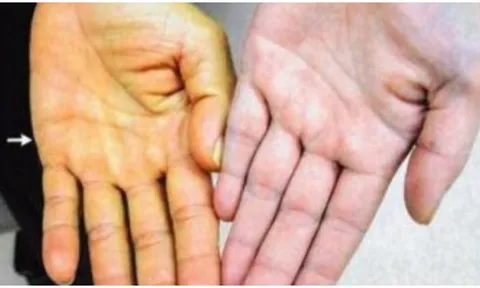 5 dấu hiệu cảnh báo bệnh gan của bạn đã đi vào giai đoạn nặng: Có 1 cũng nên đi khám sớm