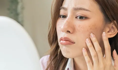 Sai lầm khiến tình trạng nám và đốm đen trở nên trầm trọng