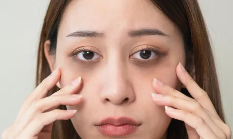 10 cách 'xóa sổ' quầng thâm mắt hiệu quả tại nhà, không cần mỹ phẩm đắt tiền hay ra spa