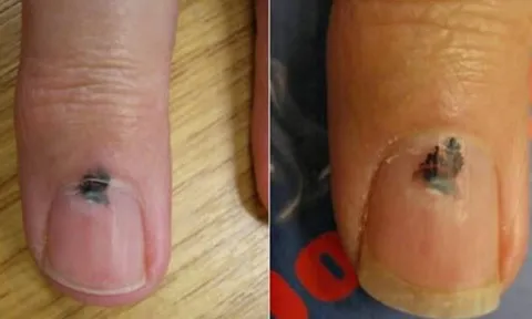 Cảnh báo sức khỏe: 6 bộ phận màu đen thường báo hiệu nguy cơ ung thư, đừng chủ quan!