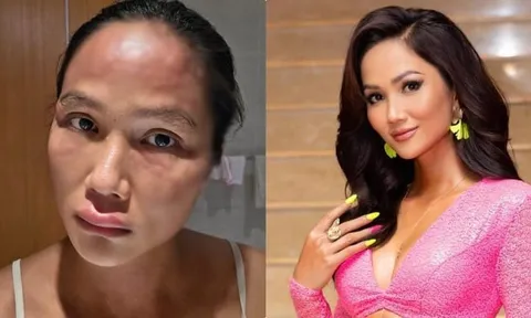 H'Hen Niê mắc bệnh sau sinh, khuôn mặt biến dạng khó nhận ra