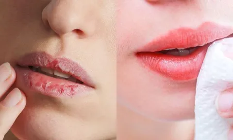 Cách trị môi khô nứt nẻ bằng nguyên liệu sẵn có tại nhà để mùa đông khô hanh nhưng môi vẫn căng mọng