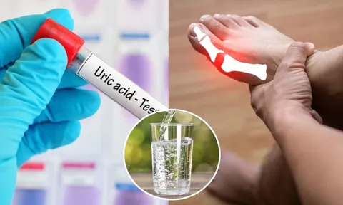 4 cách đào thải axit uric ra khỏi cơ thể nhanh chóng