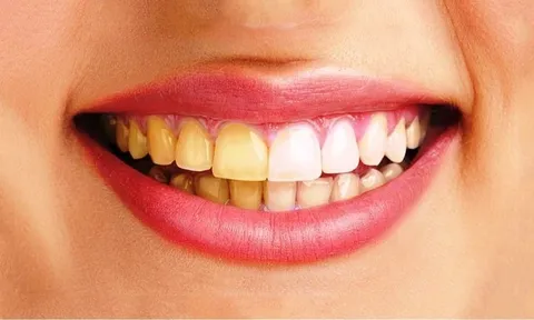 6 loại thực phẩm quen thuộc nhiều người thích mê khiến răng ố vàng dù đánh răng đều đặn mỗi ngày