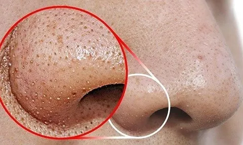 Cách chăm sóc vùng mũi giúp giảm mụn đầu đen và làm mịn da