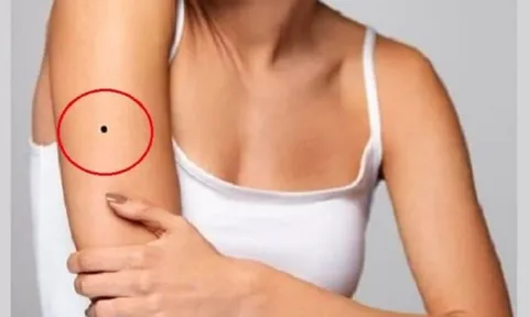 5 vị trí nốt ruồi "xấu thậm tệ", phá đường công danh, tình duyên bạn cần tẩy gấp