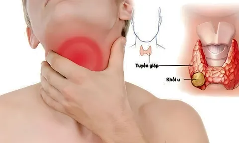 7 dấu hiệu sớm của K tuyến giáp, nhiều người chủ quan bỏ qua