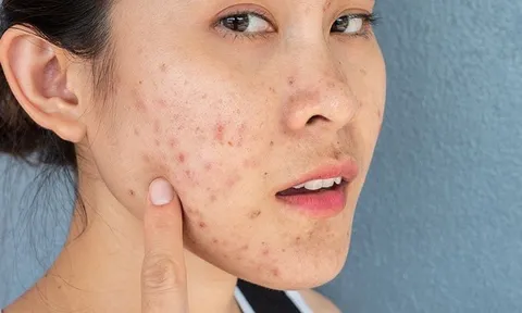 Một làn da đẹp không phải là làn da “sạch bóng” dầu