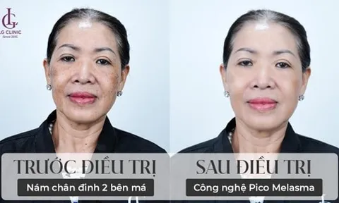 Pico Melasma - Bước tiến công nghệ vượt bậc giúp LG Clinic vươn tầm trong lĩnh vực điều trị nám da