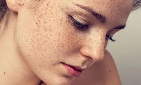 4 loại nám da thường gặp và cách điều trị