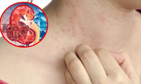 6 dấu hiệu cảnh báo suy thận, nhiều người bỏ qua