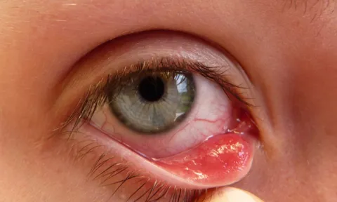 5 bệnh nhiễm trùng mắt thường gặp nhất trong mùa lây nhiễm, cần đặc biệt lưu ý