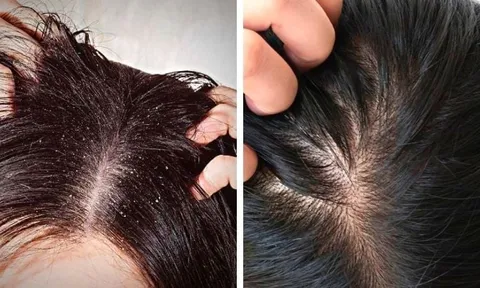 4 cách trị gàu tự nhiên giúp "đánh bay" nỗi lo về mái tóc nhiều gàu