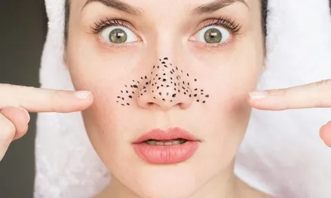 5 thói quen tưởng chừng vô hại lại dễ gây ra tình trạng mụn đầu đen