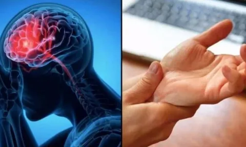 Cảnh báo đột quỵ: Dấu hiệu nhận biết trước 1 tuần, tuyệt đối không được bỏ qua