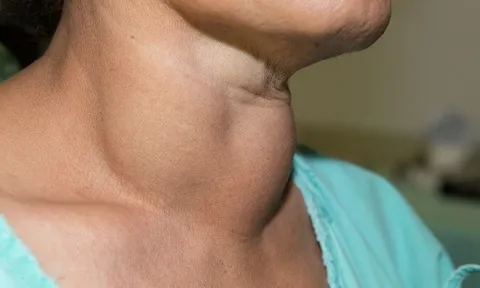 3 dấu hiệu lạ ở cổ, cảnh báo người sắp bị K tấn công