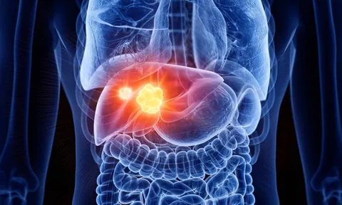 Ung thư gan gia tăng đáng báo động: Bác sĩ chỉ ra 4 thực phẩm phá gan còn nhanh hơn rượu bia